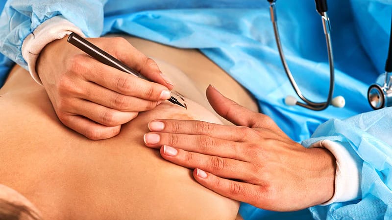 Brustvergrößerung mit Implantaten: Top-Chirurgen für optimale Ergebnisse