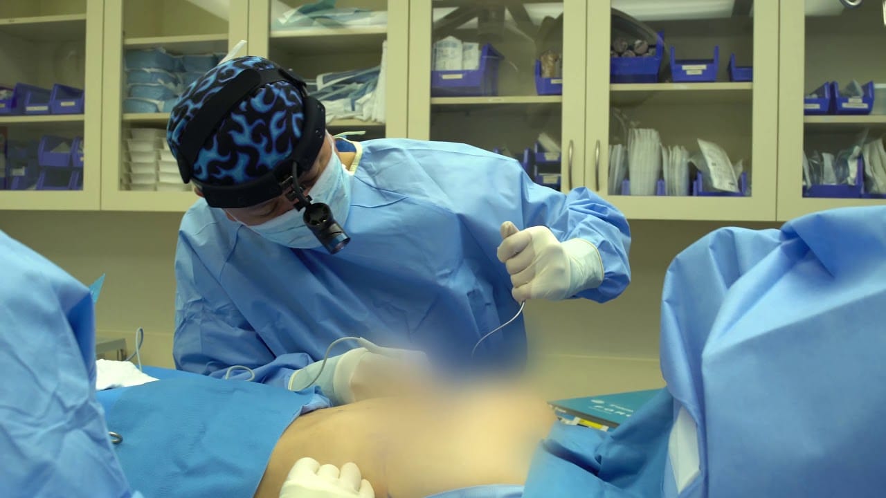 Brustvergrößerung mit Implantaten: Top-Chirurgen für optimale Ergebnisse